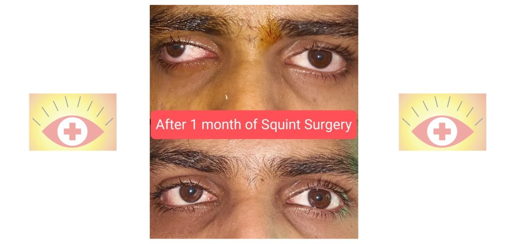 A Case of Outward Deviation of The Right Eye, by Dr. Shalin Shah