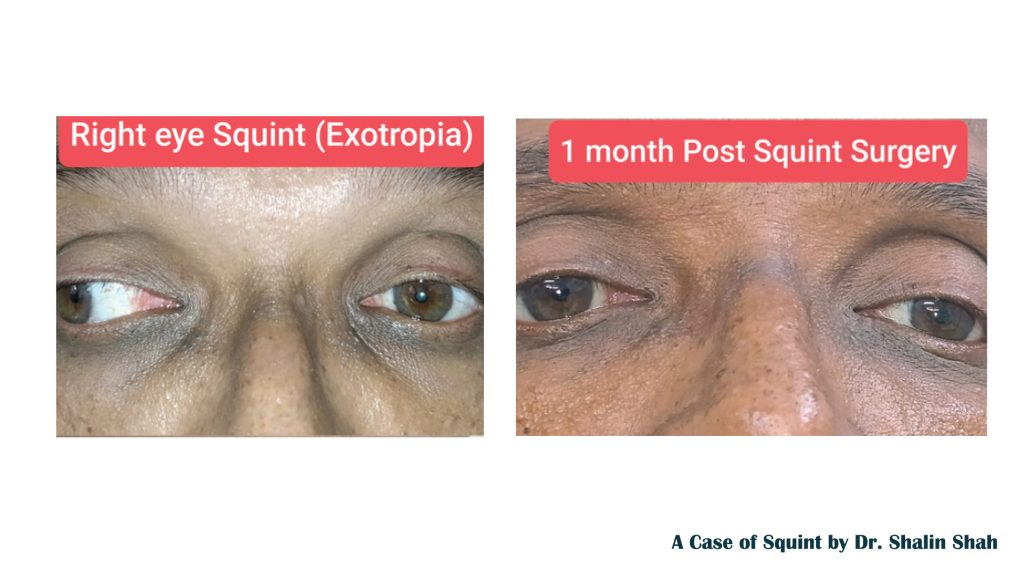 A Case of Squint by Dr. Shalin Shah