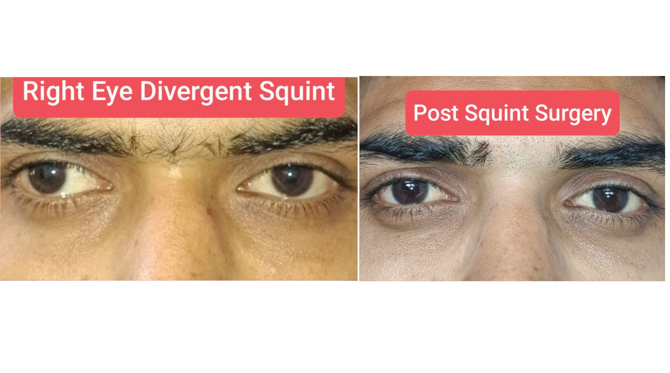 A Case of Squint by Dr. Shalin Shah